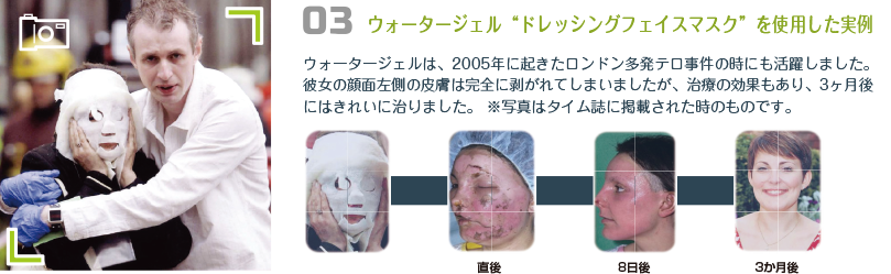 ウォータージェル“ドレッシングフェイスマスク”を使用した実例　

ウォータージェルは、2005年に起きたロンドン多発テロ事件の時にも活躍しました。
彼女の顔面左側の皮膚は完全に剥がれてしまいましたが、治療の効果もあり、3ヶ月後
にはきれいに治りました。 ※写真はタイム誌に掲載された時のものです。